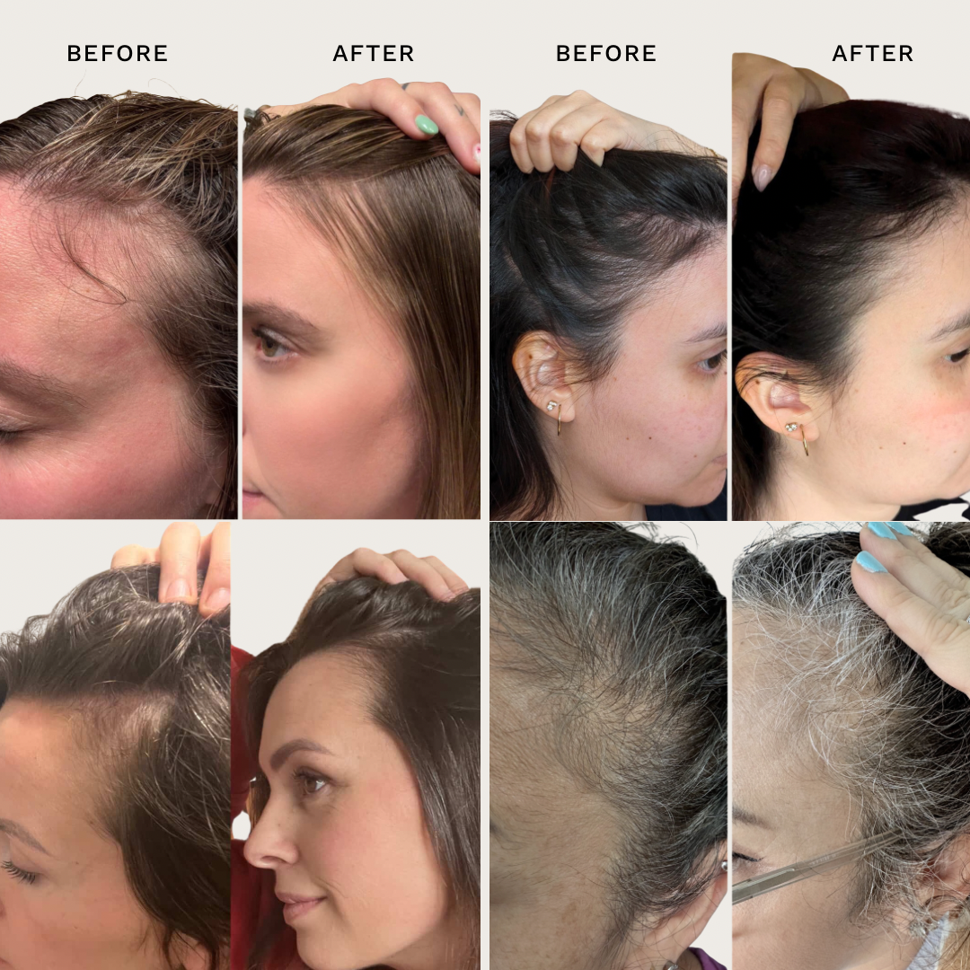 Hair Renewal Bundle for Hair Growth & Scalp Support