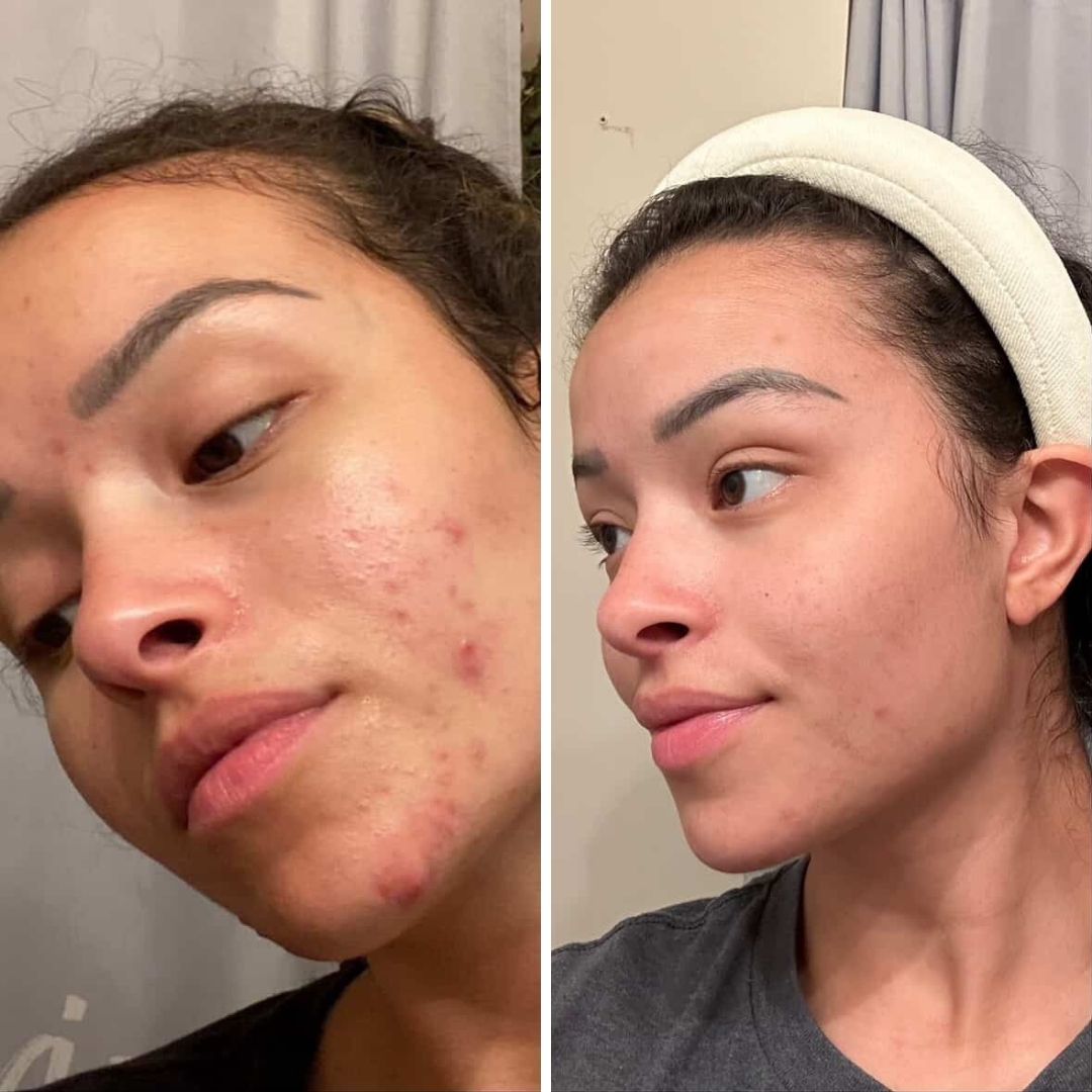 Renova Clarifying Serum (For Acne Prone Skin)