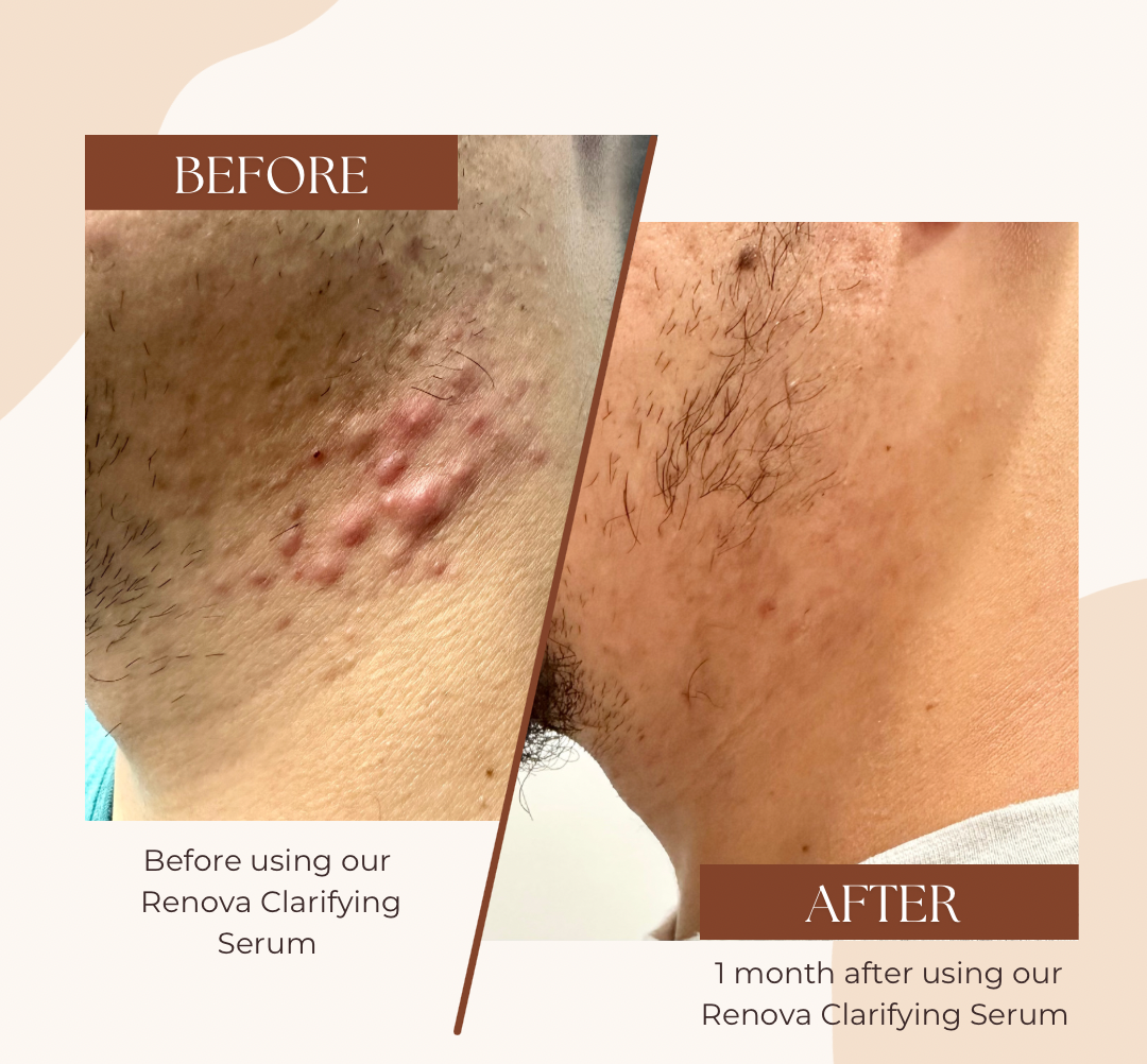 Renova Clarifying Serum (For Acne Prone Skin)